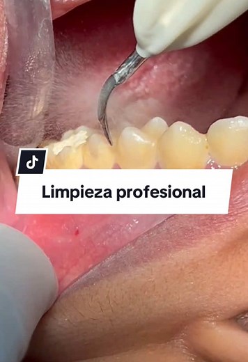 Limpieza Dental: Cómo Quitar el Sarro de Dientes