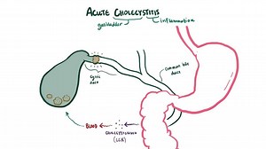 Video: Acute cholecystitis - Video Explanation! | Osmosis | Osmosis