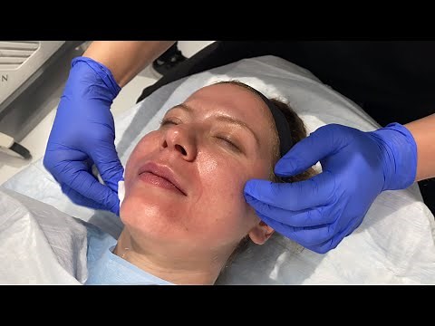 TCA CROSS for ICE-PICK, PITTED, & ROLLING BOXCAR SCARS | ACNE SCAR TREATMENT PART 1 | Dr. Jason Emer