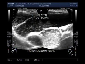 Ultrasound Video showing intestinal obstruction with dilated gut loops.