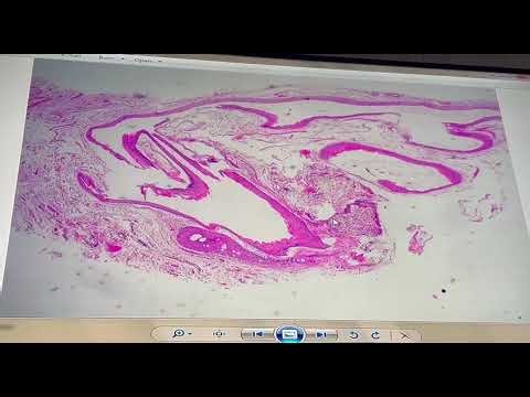 Steatocystoma multiplex histopathology by Dr. Yosra Abdel Galeil MD IDPD