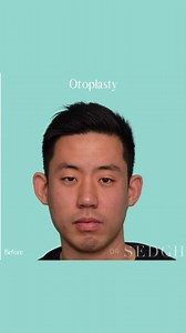 Otoplasty (Ear Pinning) Surgery Before & After