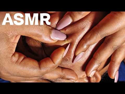 ASMR | POPPING FACE PIMPLE #nitpicking #asmr #pimple #pimplepopping #viral #pimplesremoval