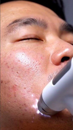 Extreme Acne Removal Compilation