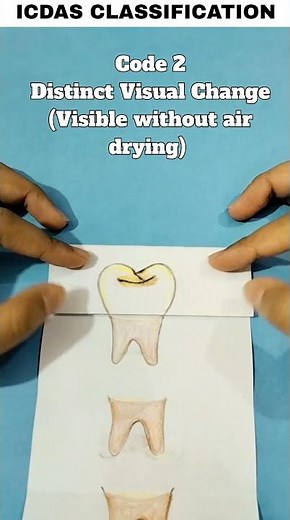 International Caries Detection and Assessment System (ICDAS) Classification