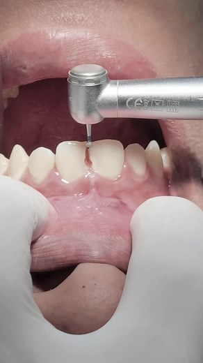Composite Restoration Techniques for Central Incisors