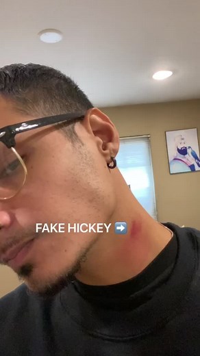Explaining a Fake Hickey Prank Gone Wrong