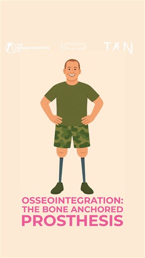 The Osseointegration Group on Instagram: "Osseointegration is an advanced surgical technique that replaces the socket prosthesis by anchoring a titanium implant directly into the bone of the residual limb. This creates a stable connection between the patient and their prosthesis without relying on soft tissue or suction. Compared to a socket, osseointegration can offer several important benefits. By removing the socket altogether, patients may avoid issues such as skin irritation, pressure point