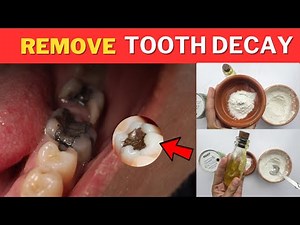 How to Remove Tooth Decay Yourself Naturally In 2 Days At Home Without Going To Dentist