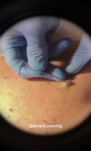 Pimple Relaxing no TikTok