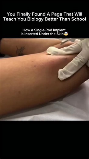 Explaining Biology on Instagram: "How a Single-Rod Implant Is Inserted Under the Skin Preparation The healthcare provider cleans your upper inner arm and marks the exact spot for insertion. Local Anesthesia A small amount of numbing medicine is injected so you don’t feel pain—just slight pressure. Insertion Using a special applicator, the provider slides the flexible, matchstick-sized rod just under the skin (not into muscle). Check Placement The provider gently feels the area to confirm the imp