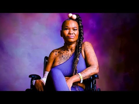 Shocking Transformation: Love and Hip Hop's Apple Watts After Horrific Car Accident