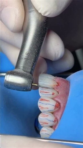 How to Finish a Composite Veneer Like a Pro #dentist #DentalEducation