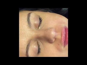 Hyaluron Pen Tutorial Pt2