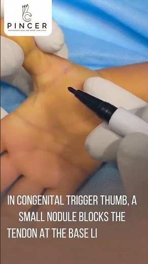 Trigger Thumb in Kids: Simple Daycare Treatment Explained | Pediatric Hand Surgeon