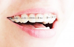Ceramic Braces Cost (UK) and Other Questions Answered