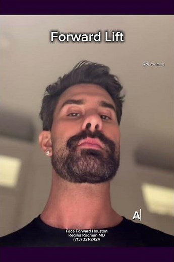 Forward Lift| Chin Augmentation| Neck Lift| Plastic Surgery