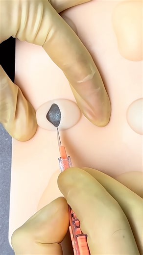 Cyst Removal and Suturing 😷 #goodtoknow #suturing #surgeonlife #funfacts #vet #medicine #lifehacks