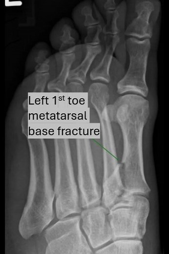 1st toe metatarsal base fracture