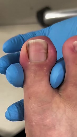 The medical term for ingrown toenails is onychocryptosis or unguis incarnates. They are more likely to occur if you wear tight shoes, have very sweaty feet, or cut your toenails the wrong way.