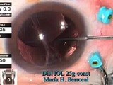 Iris-Sutured IOL with 25G Instrumentation - Eyetube