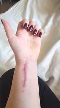 Distal radius fracture recovery