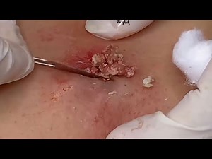 Cyst Popping and Removal (Close-Up Extraction, Ultra Relaxing)
