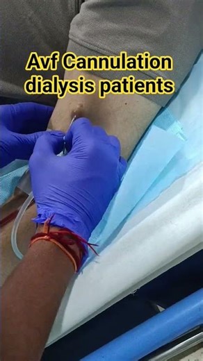 Dialysis AVF Fistula Cannulation Avf patients | Afv fistula Dialysis Cannulation