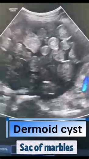 Dermoid cyst… Sac of marbles sign#Beyondtheprobe #radiology #cases #ultrasound