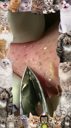 Understanding Cyst and Pimple Removal Techniques