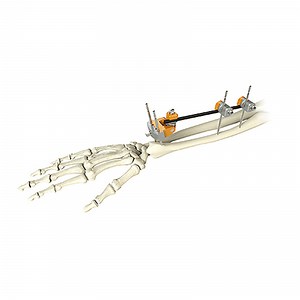 [Hot Item] Orthopaedic Implant Distal Radius External Fixator for Wrist & Ankle Fracture