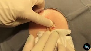 Sandra Lee, MD, FAAD, FAACS on Instagram: "NEW Pilar cyst for the long weekend! 🎉 Go to the link in my bio or my YouTube channel to watch the full sac removal of ‘Cheers to a Pilar Cyst’ now. #drpimplepopper #cyst"