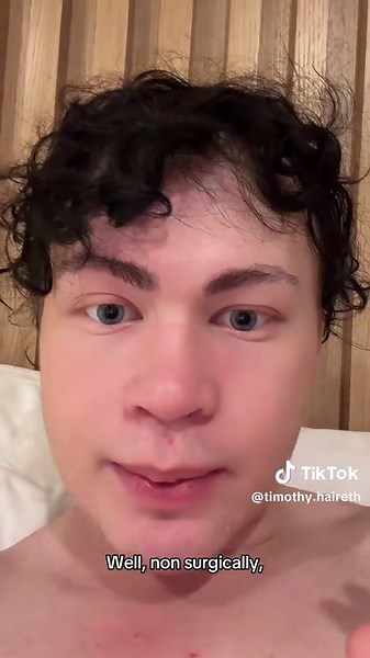 I’ll go over some more non surgical methods to fixing this in a different video What is upper eyelid exposure and how to fix it (UUE)