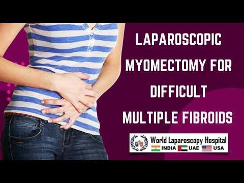Laparoscopic Myomectomy for Difficult Multiple Fibroids | Skin-to-Skin Surgical Technique | WLH