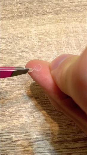 🖐️指のイボ 芯 取り👀