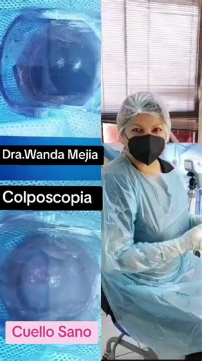 La colposcopia es un procedimiento ginecológico ambulatorio de 10-20 minutos que utiliza un microscopio especial (colposcopio) para examinar en detalle el cuello uterino, vagina y vulva. Se realiza ante citologías (Papanicolaou) o pruebas de VPH anormales para detectar células precancerosas o cáncer , permitiendo tomar biopsias dirigidas si se detectan tejidos sospechosos Procedimiento: Se coloca un espéculo para ver el cuello uterino, se aplican soluciones (vinagre/yodo) para resaltar zonas inu