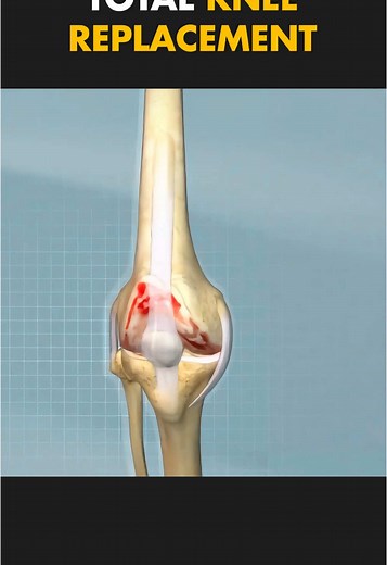 Understanding Total Knee Replacement Surgery Process