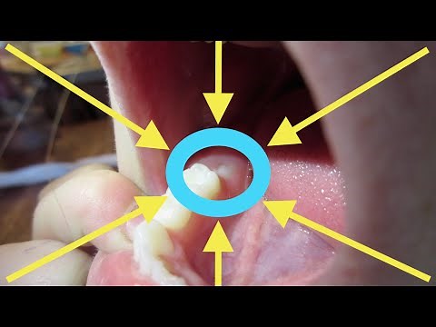 6 YEAR OLD MOLARS! (FIRST PERMANENT TEETH)