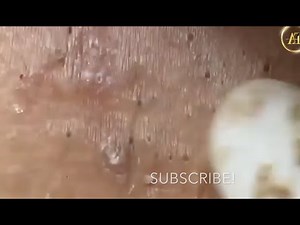 Blackhead Extractions 25.1