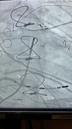 Robotic ablation of premature ventricular contractions