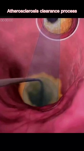 Atherosclerosis Clearance: Removing Fibrous Clots