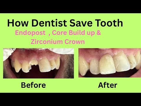 How Dentist Save Badly Broken Down Tooth | Endopost , Core Build up & Zirconium Crown