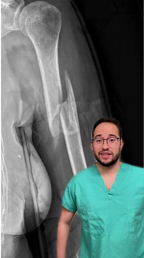 Non-Surgical Treatment for Humerus Fracture Recovery | Orthopedics