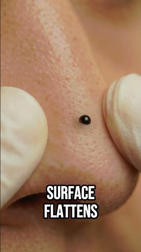 Why That Blackhead Came Back 3 Days Later #shorts #skincare #science