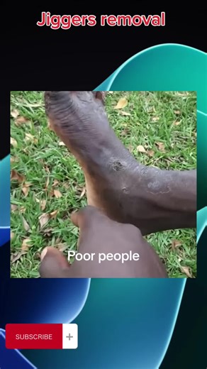 Jiggers Removal: Satisfying Cleaning in She Raj Ali's House