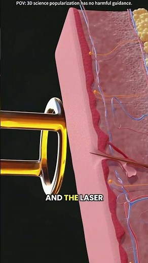 How laser hair removal works?(3D animation)