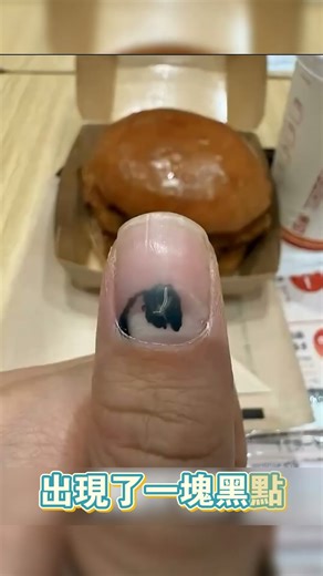 Who knew that nails would turn like this after being smashed! (TT: @brokeandbroken1)