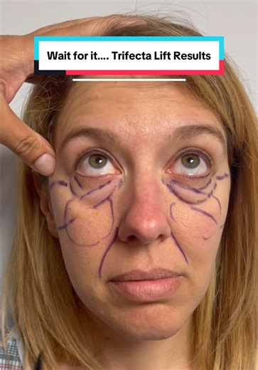 Wait for it…. 🤳 Trifecta Lift Results | Lower bleph fat transfer skin tightening. 📍Beverly Hills, CA
