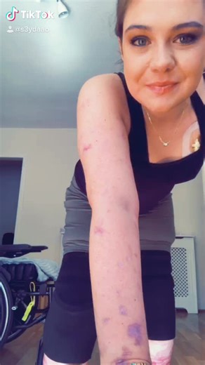 Past 8 months has been the most difficult to deal with #meningitis #sepsis #survivor #amputee #prosthetics #fyp #foryou #foryoupage