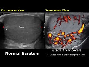 Varicocele Grading On Color Doppler Ultrasound | Grade 1-5 Varicocele | Scrotum & Testis USG